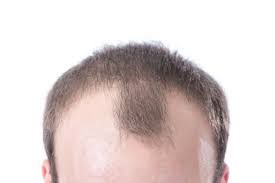 Hair Loss